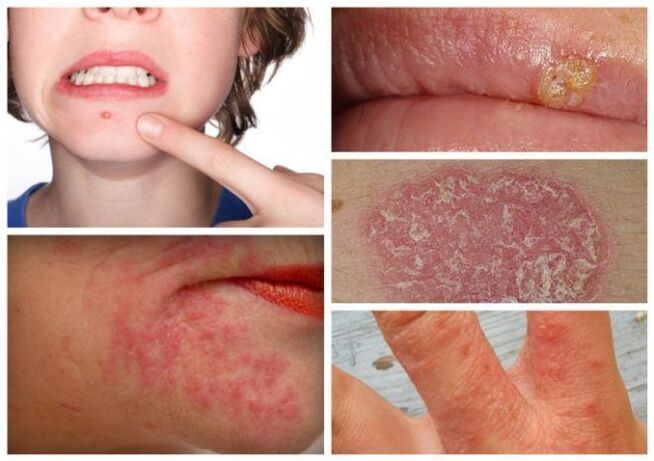 Les allergies et les maladies de la peau sont des signes de parasites dans le corps