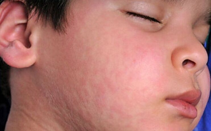 Éruptions cutanées allergiques - un symptôme de la présence dans le corps de vers parasites