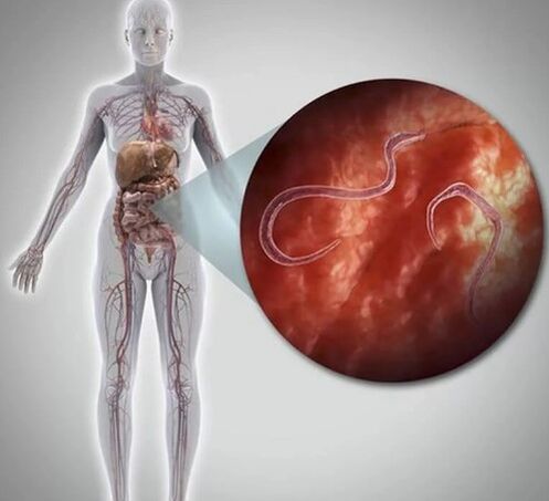 Parasites dans le corps
