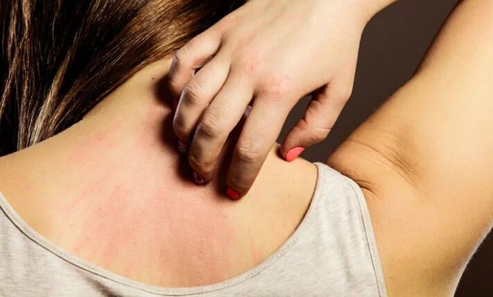allergie