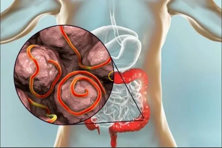 Parasites dans l'organisme humain