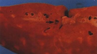 Quels parasites peuvent vivre dans le foie humain